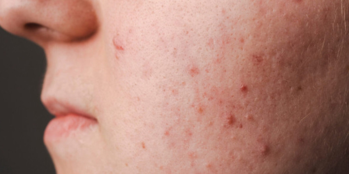 Acne Scar Treatment in Mumbai: Restore Smooth, Clear Skin